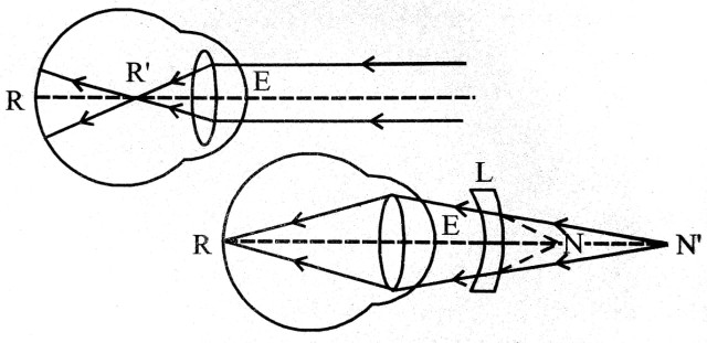 Defects of Vision